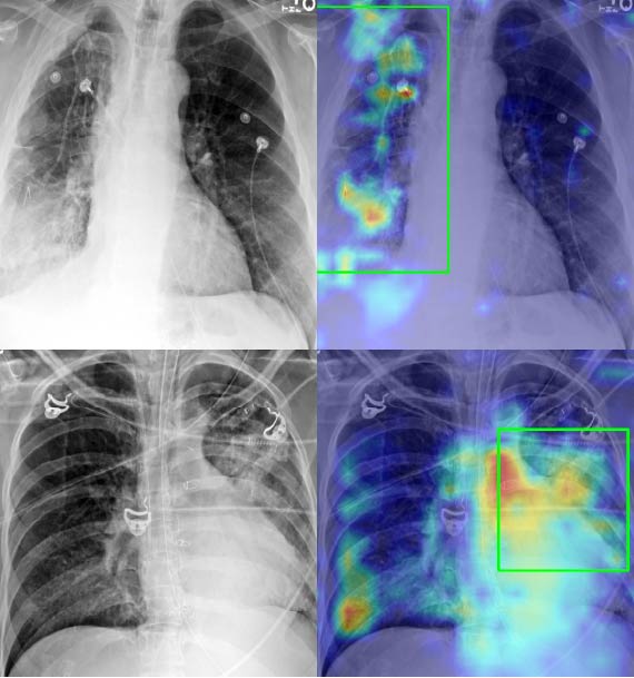 AI Powered TB